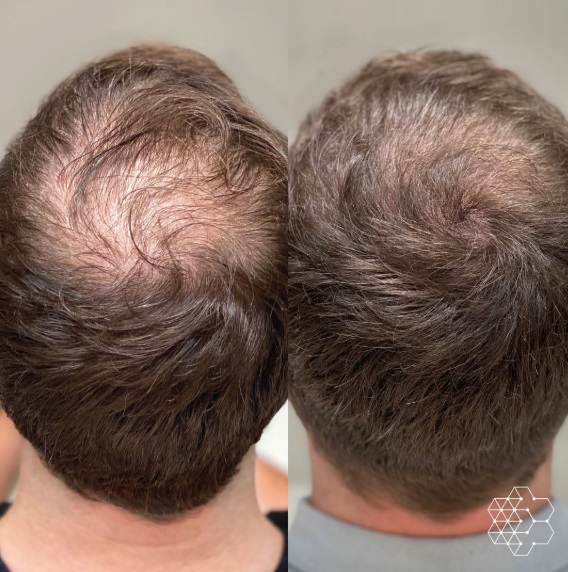 PRP Scalp Treatment
