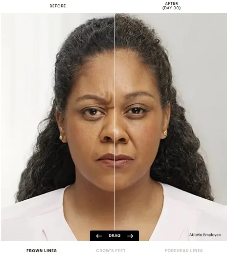 Botox Before and After – New Photo