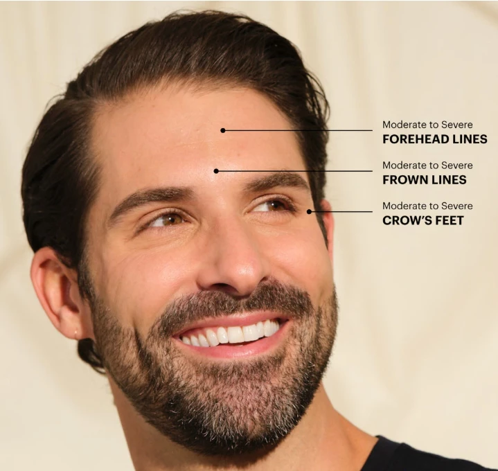 Botox Treatment Areas