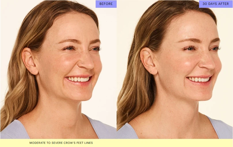 Botox Before and After