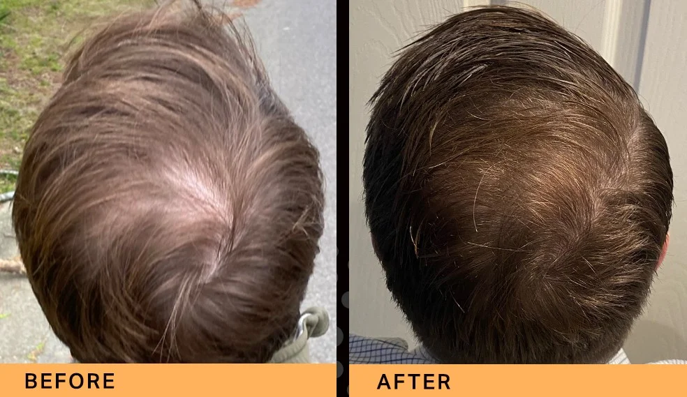 Keravive Before After