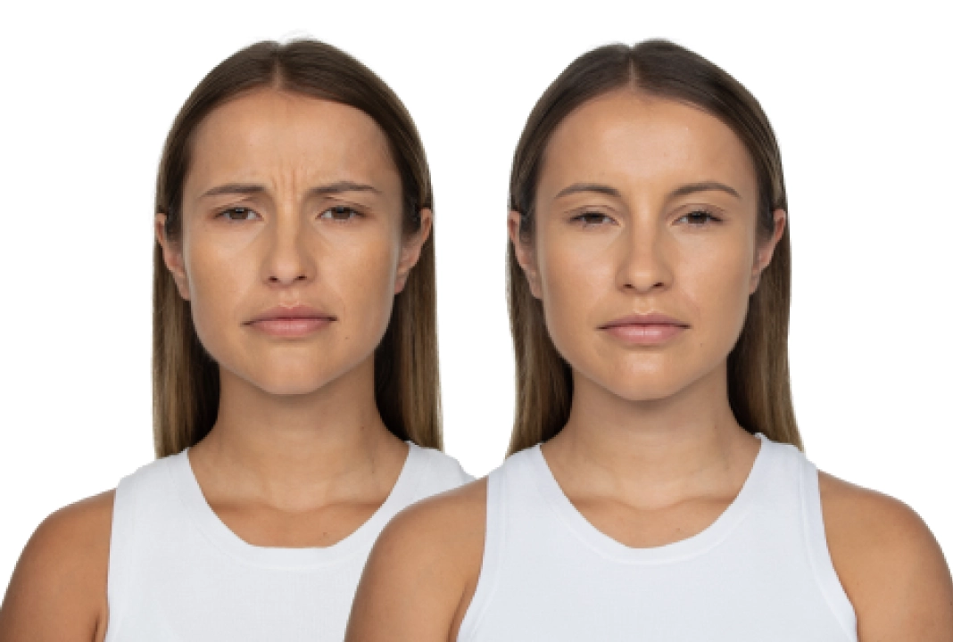 Jeuveau before and after 1