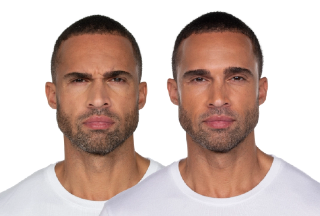 Jeuveau before and after 2