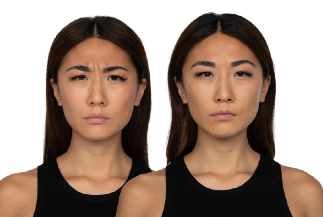 Jeuveau before and after 3