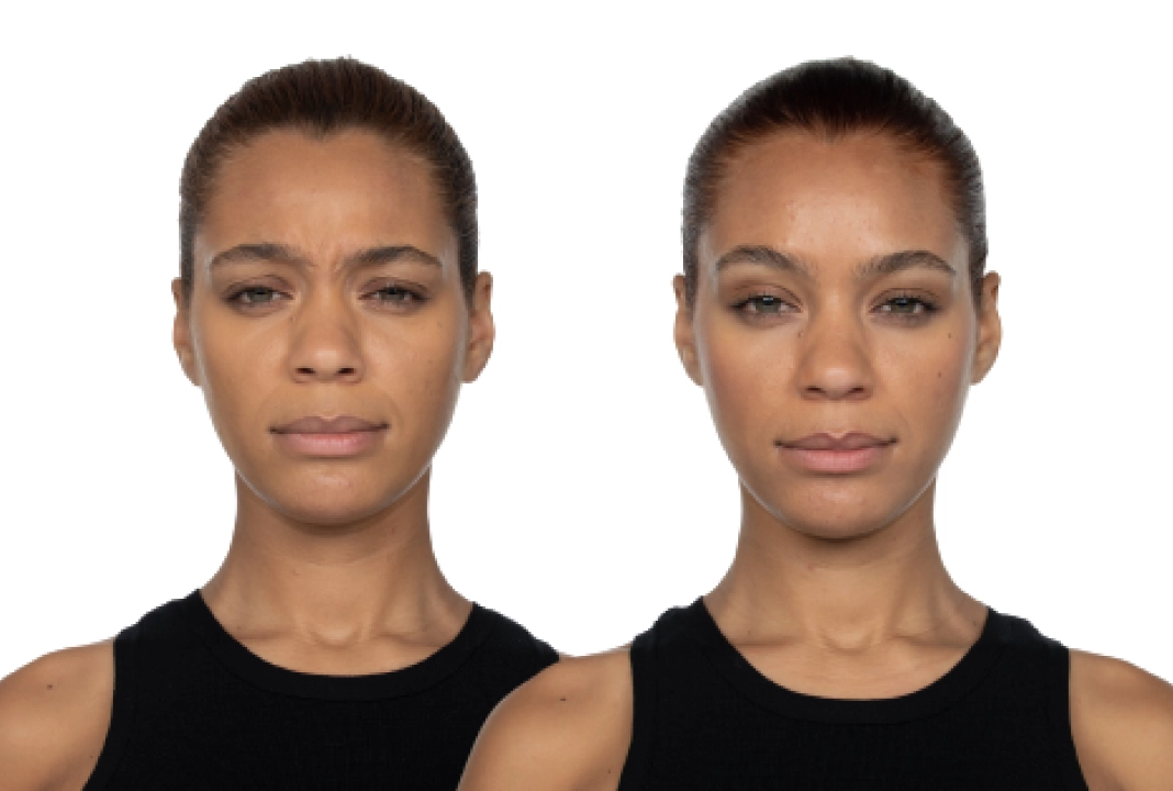 Jeuveau before and after 4