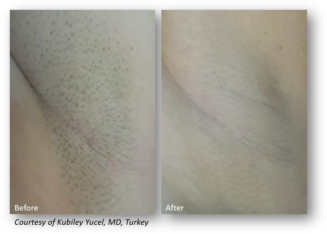 Laser Hair Removal Before and After 1