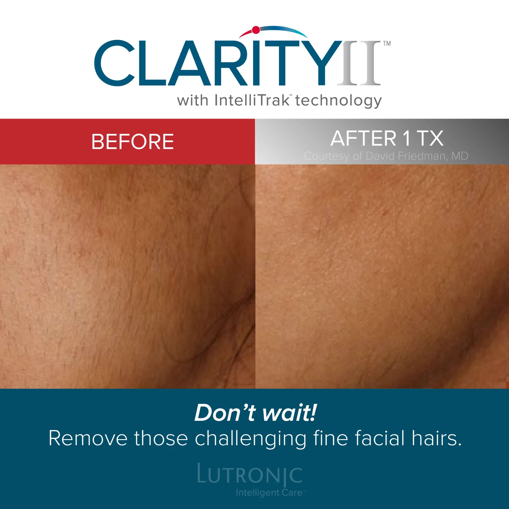 Laser Hair Removal Before and After 2