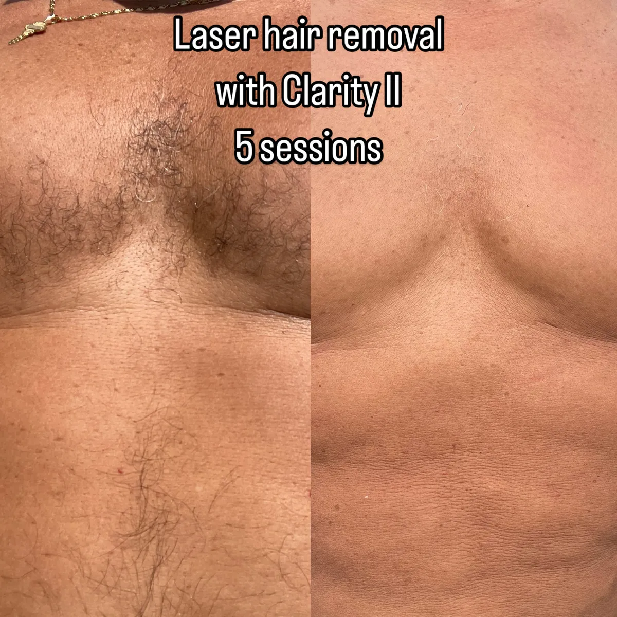 Laser hair removal before and after with Clarity II